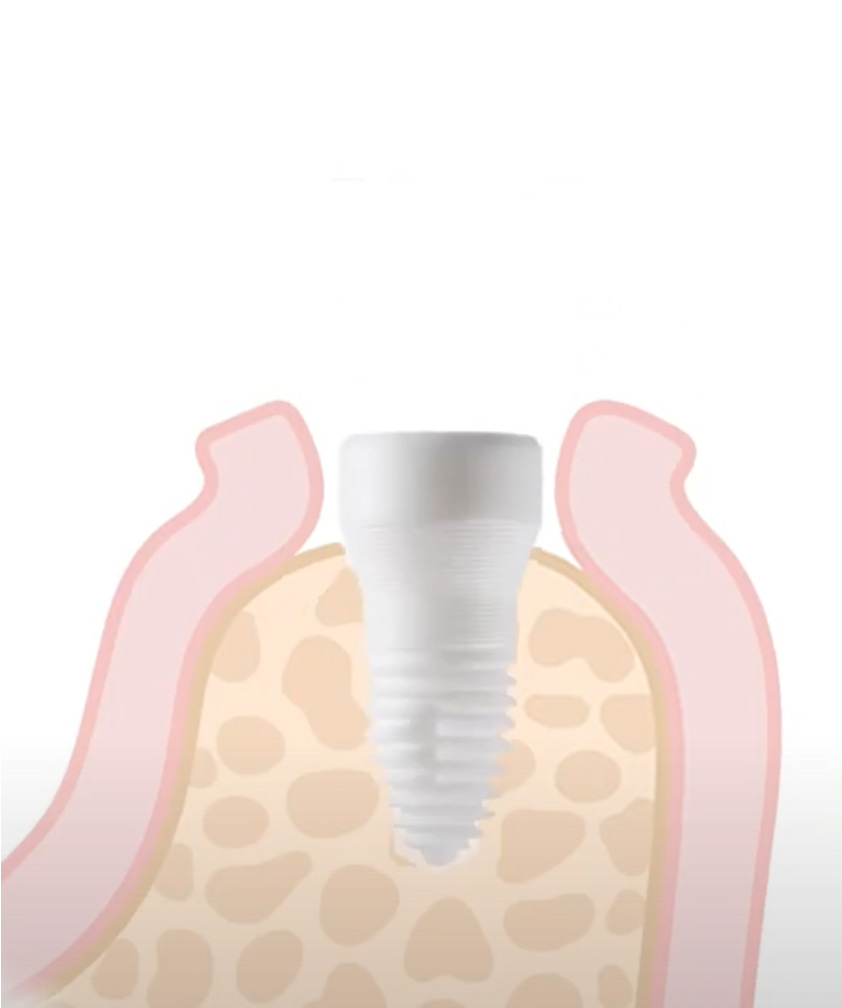 Implantat Schritt 3